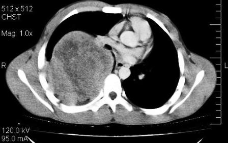 Figure 1: CECT thorax showing extra-parenchymal mass right upper and middle hemithorax